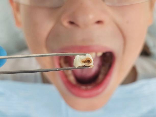 Best Pediatric Emergency Dentist in Colfax, LA